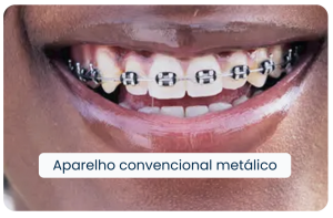Aparelho ConvencionalMetálico
