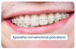Aparelho Convencional Porcelana