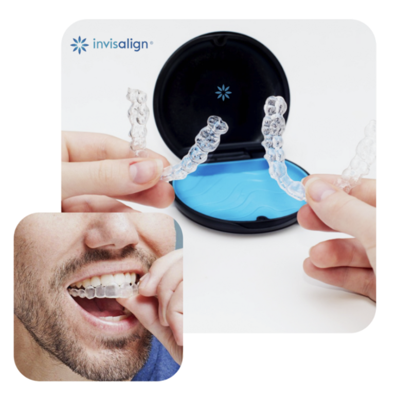 Invisalign, Alinhador-Transparente