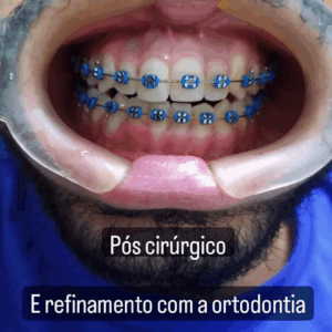 antes e depois aparelho ortodôntico