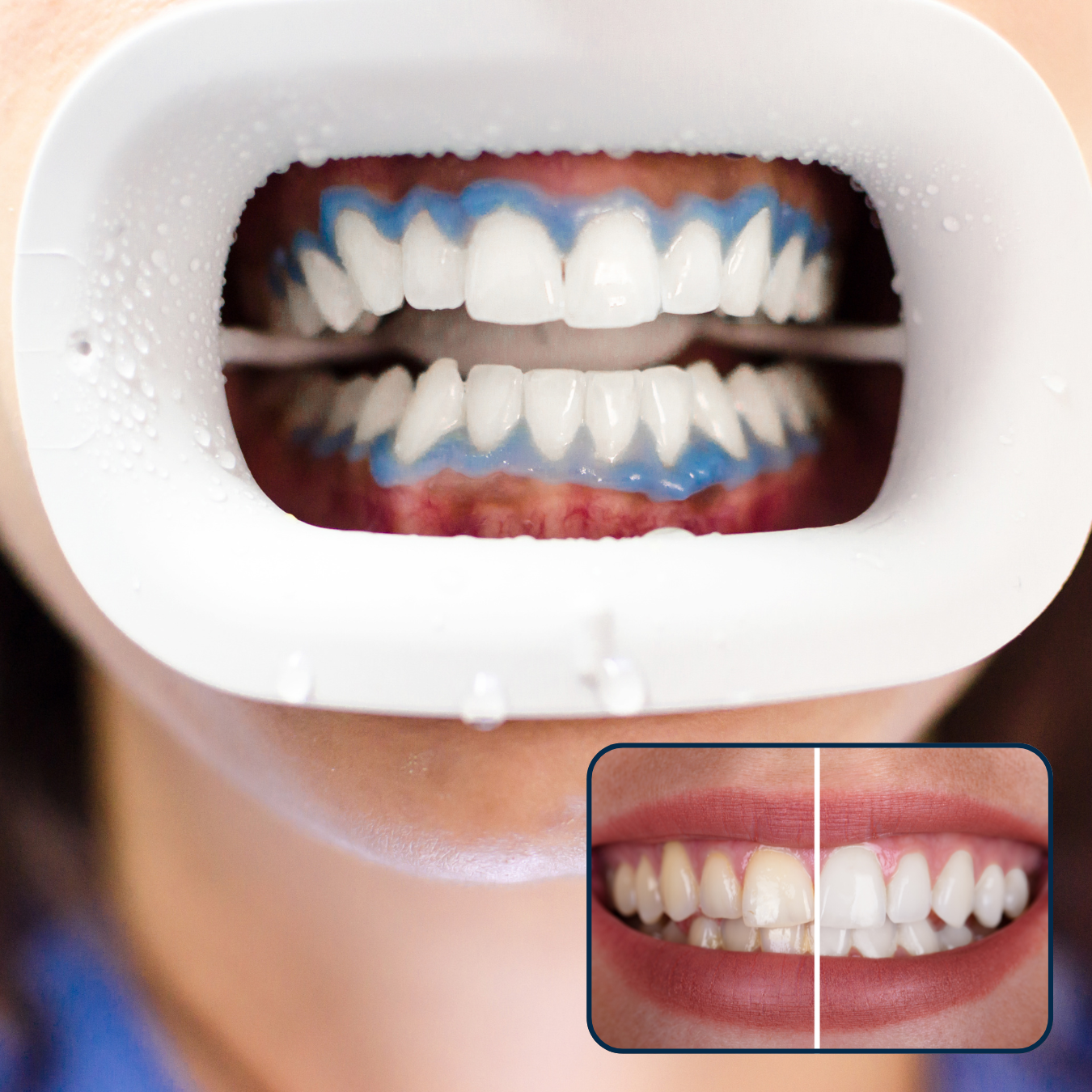 Clareamento_Dental_Consultório_Trinity_Odontologia_Integrada