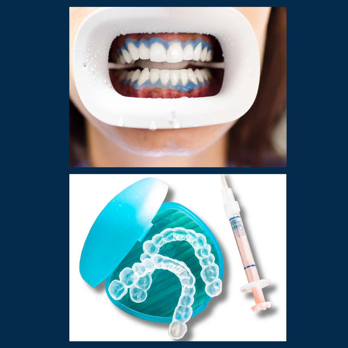 Clareamento de Consultorio e Caseiro_Trinity_Odontologia_Integrada