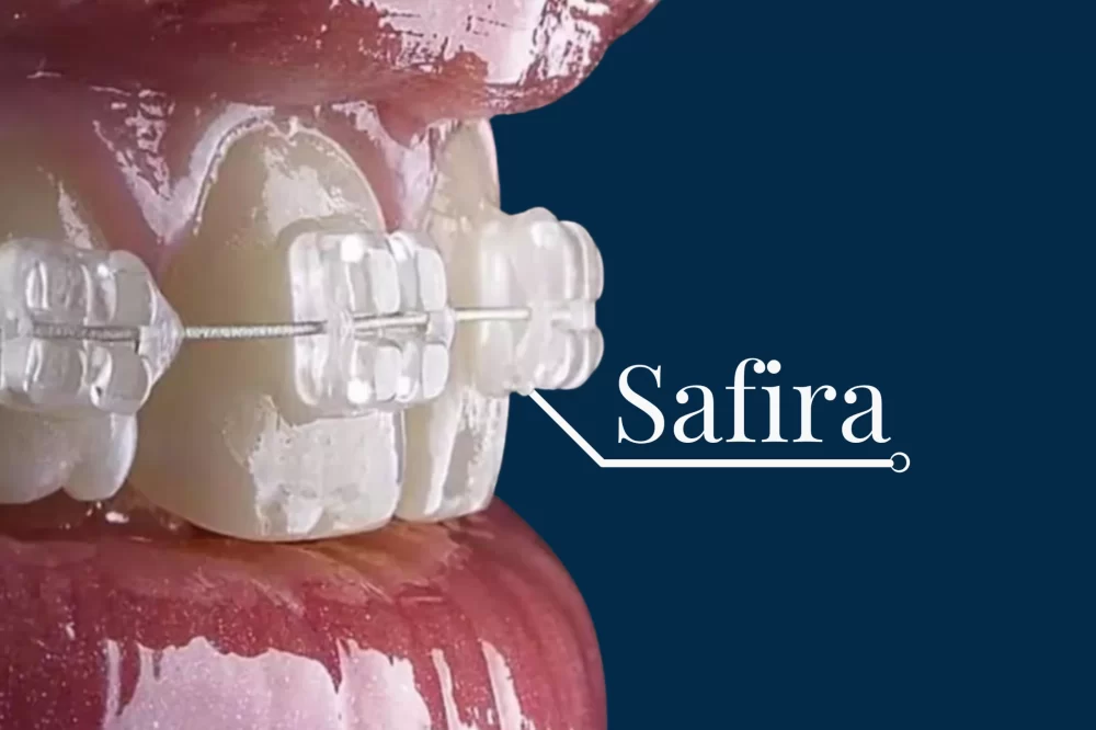 Aparelho_Safira_Trinity_Odontologia_Integrada